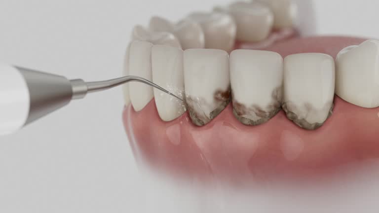 Trusted Wisdom Tooth Removal service in Dalton, PA - Dentist Open Now